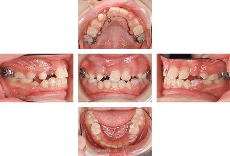 埋伏歯− 症例2の写真