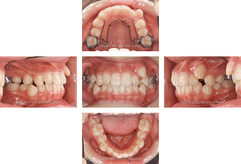 埋伏歯− 症例3の写真