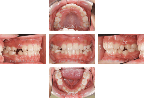 埋伏歯− 症例3の写真