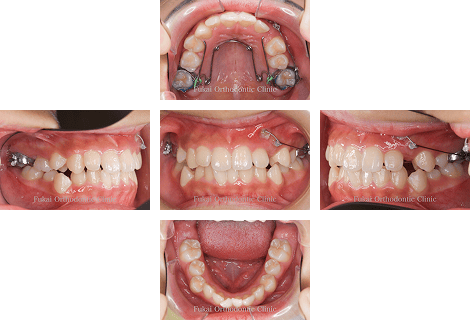 埋伏歯− 症例3の写真