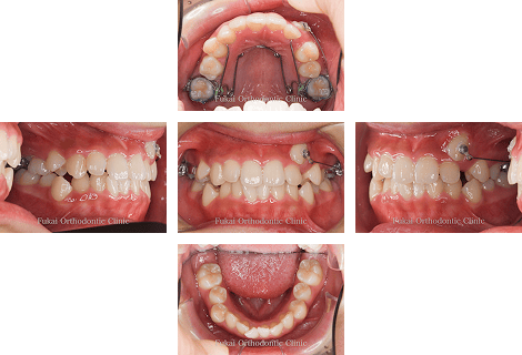 埋伏歯− 症例3の写真
