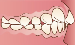 出っ歯(正式名は上顎前突(じょうがくぜんとつ))のイラスト
