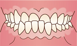 受け口(正式名は反対咬合(はんたいこうごう)、下顎前突(かがくぜんとつ))のイラスト