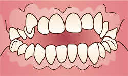 開咬(かいこう)(別名、オープンバイト)のイラスト