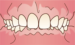 過蓋咬合(かがいこうごう)のイラスト