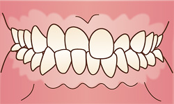 交叉咬合(こうさこうごう)のイラスト