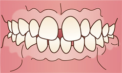 すきっ歯(正式名は空隙歯列(くうげきしれつ)、正中離開(せいちゅうりかい))のイラスト