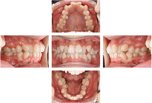 治療前:本格的治療 叢生-症例1