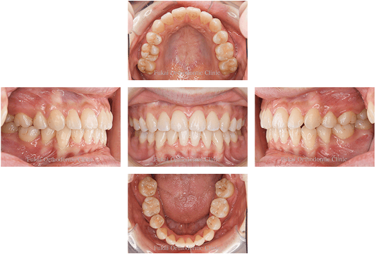 治療後:本格的治療 叢生-症例1