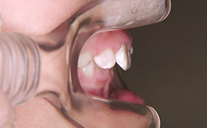 初期治療「出っ歯」治療前