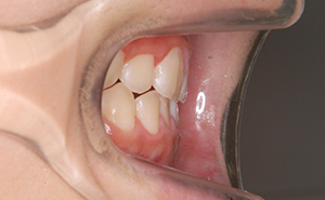 初期治療「前歯のガタガタ」治療後