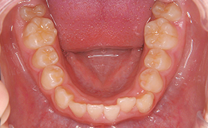 初期治療「前歯のガタガタ」治療後