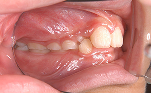 初期治療「前歯のガタガタ」治療前