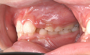 初期治療「前歯のガタガタ」治療前