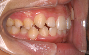 初期治療「かみ合わせが深く出っ歯」治療後