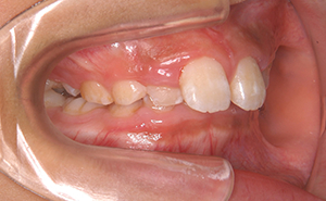 初期治療「かみ合わせが深く出っ歯」治療前