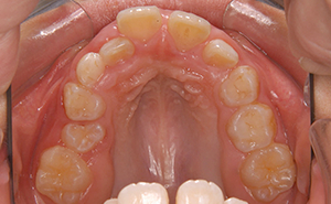 初期治療「かみ合わせが深く出っ歯」治療前