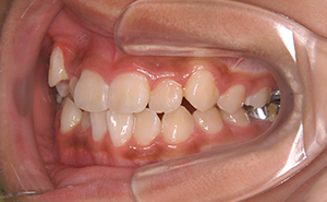 初期治療「前歯のガタガタ」治療中