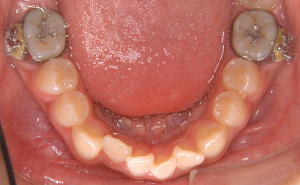 初期治療「前歯のガタガタ」治療中
